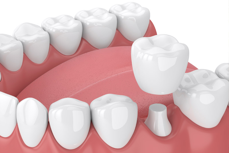 Dental Crowns in Havertown
